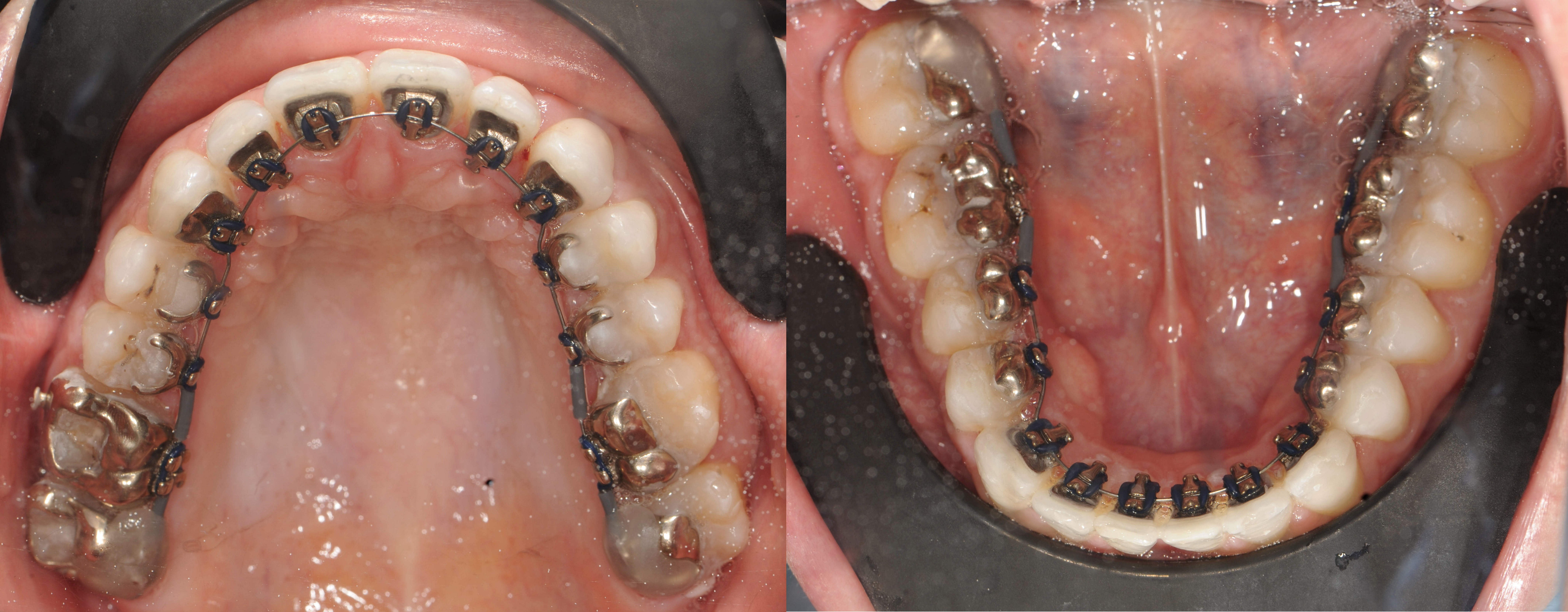 Orthodontie adulte : indications, prix, remboursement