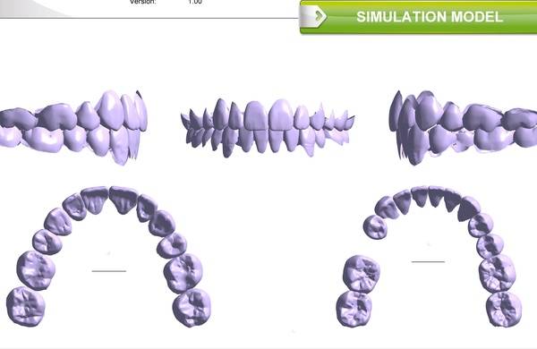 Orthodontie pré-implantaire