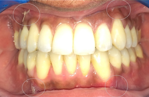 Corticotomies Mini Invasives