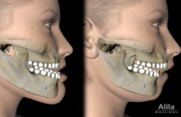 Principales chirurgies des maxillaires