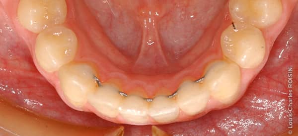 L'importance de la contention en orthodontie